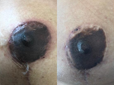 45-54 year old woman treated with Nipple Surgery - Previous areolar scaring, reconstruction with tattoo camouflage .