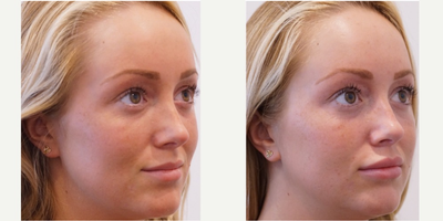 18-24 year old woman treated with Restylane - This gorgeous young lady desires fuller lips.  New lip filler product Restylane Silk composed of hyaluronic acid is injected into her upper and lower lips using the latest cannula technique.