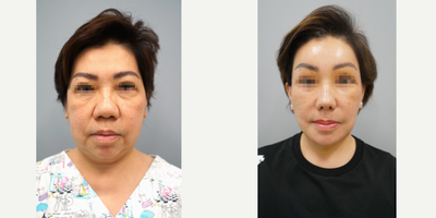 Facelift, Necklift, Rhinoplasty, Genioplasty, Browlift - Anti-aging- Deep Plane Facelift- Platysmal Necklift- Sub-Brow liftRhinoplasty - 100% Rib Cartilage Rhinoplasty- Mid-face AugmentationGenioplastyPerformed by Dr. Myung Ju Lee of VIP Plastic Surgery Korea