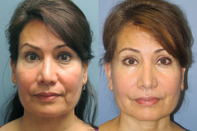Chin Augmentation - 
	This 47-year-old woman underwent a Chin Augmentation.

