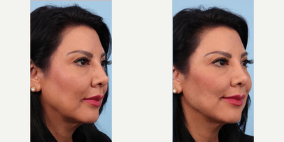 Woman treated with Facelift, Bellafil - This lovely patient underwent a non-surgical liquid facelift with 4 syringes of Bellafil. Bellafil is a collagen-based dermal filler with polymethyl methacrylate (PMMA) microspheres. The collagen gel provides immediate volume and lift to correct volume deficit.Once injected, the microspheres stay in place and create a supportive scaffold for your own collagen to develop. The result is natural, immediate, and long-lasting with minimal downtime. The result can last up to 5 years, and it's the longest lasting dermal filler on the market!