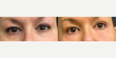 Woman treated with TCA Peel - Before and After upper and lower eyelid blepharoplasty and 30%n TCA peel on this beautiful 55- year old patient. I was using filler under her eyes with good results until last year when it stopped working.