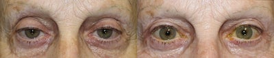 65-74 year old woman treated with Ptosis repair on upper eyelids. - 65-74 year old woman treated with Ptosis repair on upper eyelids.