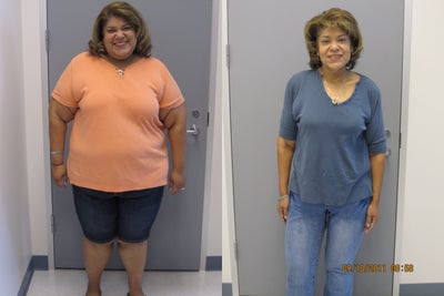 Gastric Bypass  - laparoscopic Gastric Bypass, high patient satisfaction. Expected results with very compliant patient.