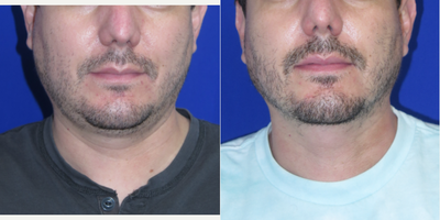 36 year old man treated with Chin Liposuction - 36 year old male who didn't like the fullness in his neck. Patient had chin liposuction under local anesthesia with oral sedation.