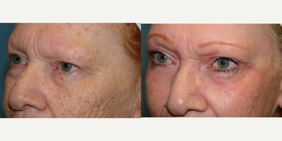 65-74 year old woman treated with Chemical Peel - Deep chemical peel with phenol (Hetter peel) combined with dermabrasion on the full face.  No additional surgery performed