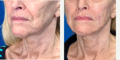 65-74 year old woman treated with Endolift, Nonsurgical Facelift, Miracu, Nonsurgical Neck Lift, Thread Lift - Endolift Laser tightens lax tissue, contours and stimulates your collagen. Using the Endolift Laser the face, cheeks, jawline and neck were tightened, smoothed and supported with PDO Threads. This is an outpatient office procedure with minimal discomfort during or after the procedure and rapid recovery. As the entire procedure is performed through tiny pin holes. The skin continues to improve as collagen within your skin is stimulated. Not only is there a lift and contour improvement but the quality of the skin is remarkably improved.