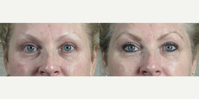 35-44 year old woman treated with Halo Laser - This patient was bothered by hyperpigmentation and fine lines on her skin. She was looking for an overall improvement in the appearance of her skin and fine lines. We used our Halo laser to treat her skin. The treatment evened her skin tone, added firmness, and reduced her fine wrinkles.&nbsp;
