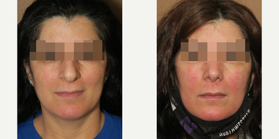 Woman treated with Rhinoplasty - Woman treated with Rhinoplasty