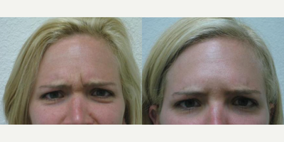 Woman treated with Botox - Botox Cosmetic
