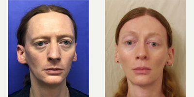 Patient treated with Rhinoplasty, Septoplasty - Septorhinoplasty (open) with Cartilage Grafts and Weirs - 35 to 44 year-old female patient is 1 year post-op from Facial Feminization surgery. Her procedures included: Forehead Lift, Hairline Lowering, Orbital Bony Contouring, Septorhinoplasty (open) with Cartilage Grafts and Weirs, Thyroid Cartilage Shave Revision, Chin Reduction and Contour, Cheek Implants (small), Intranasal Lip Lift, and Soft Tissue to Lips.