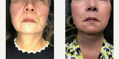 Woman treated with Mini Facelift - Woman treated with Mini Facelift