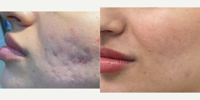 18-24 year old woman treated with CO2 Laser, Skin Rejuvenation, SkinCeuticals - Combination acne therapy to enhance our clients skin and reduce the appearance of her acne scarringTCA cross, subcision, CO2 laser, and BellaFill are included in acne scar packages and help to achieve the best results!