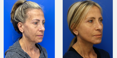 55-64 year old woman treated with Deep Plane Facelift - 58 year old patient 3 weeks after Facelift, Neck lift and co2 laser. She had an upper eyelid blepahroplasty done by Dr. Madnani a year and a half ago as well.