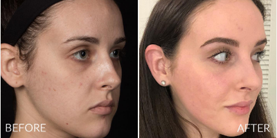 Woman treated with Laser Resurfacing, Microneedling RF, PRP Injections, Subcision - Woman treated with Laser Resurfacing, Microneedling RF, PRP Injections, Subcision