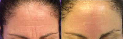 25-34 year old woman - Tempsureenvi RF treatment . Instant result for your D day glow ! Feel beautiful every day ! 4-5 treatments one month apart will give you long Lasting results . Collagen regrowth stimulation , skin tightening and wrinkles smoothening .