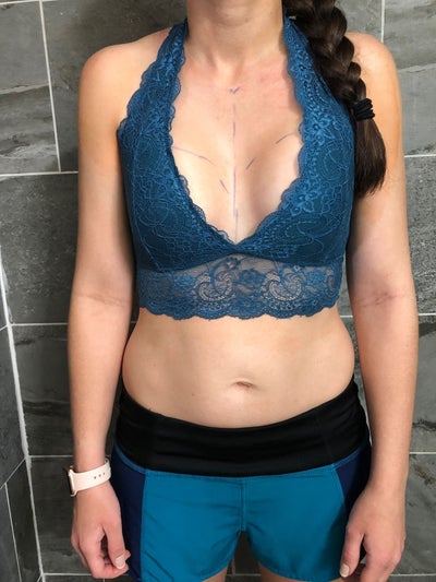 27 Years Old, 5'4, 125 Pounds, 32F/34E - Review - RealSelf