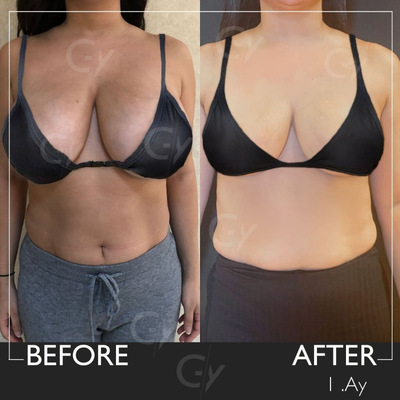 35-44 year old woman treated with Breast Reduction - Breast Reduction by M.D. Gray Yeiladal