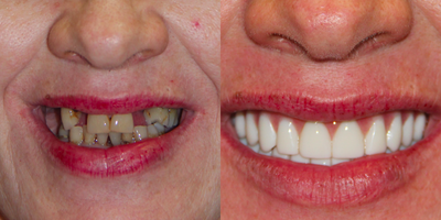 All-on-4 Dental Implants - All-on-4 Dental Implants