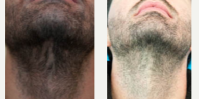 25-34 year old man treated with SmartGraft - SmartGraft Beard Transplant Before And After