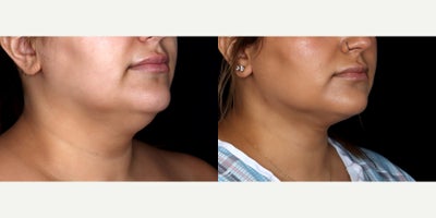 32 year old woman treated with PrecisionTx - 32 year old woman treated with PrecisionTx. Photos depict before and 6 weeks after surgery