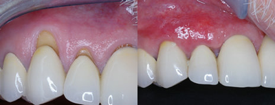 Gum Graft - PT had svere recession of gums in his upper left front teeth. The post operative picture shows excellent root coverage and healthy gum tissue. The recession is no longer present and there is excellent tissue health. The procedure performed was a soft tissue graft using human allograft (Alloderm). The patient is very happy now since he does not have to hold back his smiles