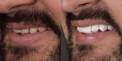 25-34 year old man treated with BriteSmile, Lumineers, Porcelain Veneers, Smile Makeover, SmileDirectClub - We improved the color and shape of the teeth with composite veneers