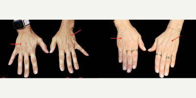 Woman treated with Hand Rejuvenation - Did you know that your hands can look more youthful using fat that is removed during a tummy tuck or mommy makeover? During body procedures, liposuction is often used to help improve contours. Instead of throwing away this fat, it can be transferred (i.e. grafted) to other parts of the body including the face and hands.This patient was getting married 6 weeks after her mommy's makeover and wanted to make sure that her hands looked great in the ring photos. She got a beautiful and natural result!