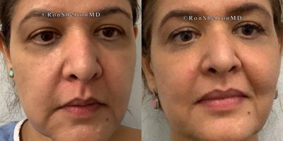 45-54 year old woman treated with Ultherapy, Sofwave, Nonsurgical Facelift - 49 YO woman treated with ultherapy and sofwave lifting lower face and replacing lost mid cheek volume. No fillers were done