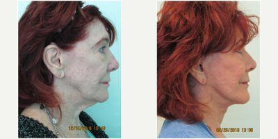 65-74 year old woman treated with Lower Facelift and Necklift Revision - This woman presented two years after having a lower facelift and necklift performed by another surgeon.  She had been satisfied with her initial result, however, she noticed significant return of jowls and neck laxity/looseness only a few months after her procedure.  She presented to our Center with the request of a re-lift of both her neck and jawline.Under local anesthesia and mild oral sedation with valium, we performed a revision lower facelift and necklift in our Center.  Her results demonstrate a much improved jawline along with better contour under her chin.
