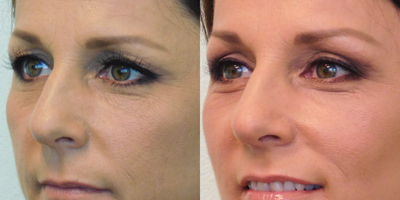 47 year old woman treated with Brow Lift and Upper Eyelid Lift - This active woman in her mid-40's presented to our Center with the request of rejuvenation of her eyes. She was concerned with the heaviness over the upper eyelids. Her evaluation demonstrated significant excess thin skin over the lids, along with moderate drooping of the outer corners of her eyebrows. The treatment plan we decided on was to perform an upper eyelid lift (blepharoplasty) with a lateral brow lift. Both procedures were performed on the same day under local anesthesia with mild oral sedation in our Center. The upper eyelid incisions were placed in the natural crease of the upper eyelids, and the brow incisions placed in the scalp where they could not be seen.Her results demonstrate eyes that appear much more awake and lively, but at the same time quite natural in appearance. The recovery time was approximately one week.