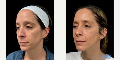 35-44 year old woman treated with NeoGen Plasma - This lovely patient is experiencing improved results -- shown at 30 days post NeoGen treatment.