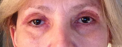 How do you stretch eyelid skin after a terrible blepharoplasty? What ...