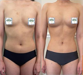 Woman treated with Breast Fat Transfer - Woman treated with 400cc Breast Fat Transfer