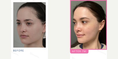 25-34 year old woman treated with V Line Surgery, Rhinoplasty - LA, Rh