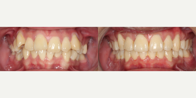 25-34 year old man treated with Braces - Crowding treated with braces.