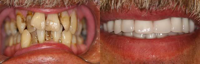 Dental Implants - 
	PT presented with poor condition of teeth. Neglect for several years. All teet hwere removed becasue of periodonatl gum disease and decay, bone was smoothed, some bone grafting performed and six dental implants placed upper jaw and six implants placed lower jaw with porcelain bridges

