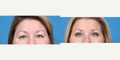 35-44 year old woman treated with Double Eyelid Surgery - Bilateral upper lid blepharoplasty