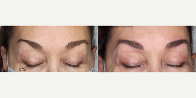 Woman treated with Microblading - Woman treated with Microblading