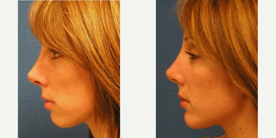 Woman treated with Chin Implant - Woman treated with Chin Implant