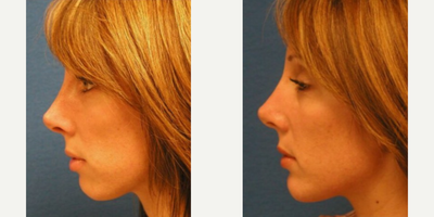 Woman treated with Chin Surgery - Woman treated with Chin Surgery using implant