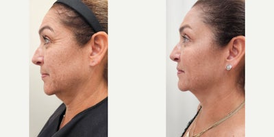 55-64 year old woman treated with Dysport, Sculptra, Radiesse, Alastin Skincare - Tailored treatment plan with combined procedures on same session: Dysport on upper third of the face2 vials of Sculptra for the whole face2 vials of reconstituted Radiesse for the neckAlastin Skincare started after her first consultation