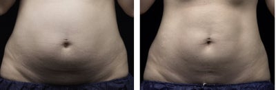 LIPOSONIX - Liposonix Abdomen
