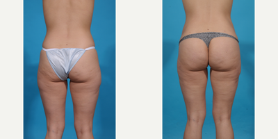 25-34 year old woman treated with Brazilian Butt Lift, Brazilian Butt Lift Revision, Butt Augmentation, Butt Lift, Liposculpture - Skinny BBL. This patient wanted better shape and curves without too much volume. A skinny BBL prioritizes shape over size and is perfect for athletic women who just need a better shape, more curves, and projection but don't want too much volume in their butt. We call this a skinny BBL.