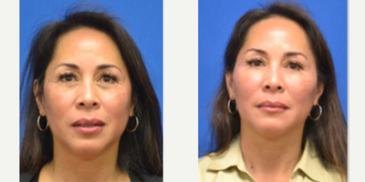 55-64 year old woman treated with Cheek Fillers, RHA Collection Fillers - Filler placed in the Y Lift method