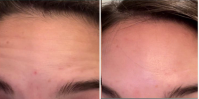 Woman treated with Botox for Forehead Wrinkles - This woman wanted to smooth out her skin with preventative Botox. Although she hadn't formed wrinkles yet she had fine lines that needed smoothing over and wanted to prevent wrinkles from forming. I used a modest 14 units to keep the lines from forming and smooth out pre-existing fine lines and slight wrinkles.