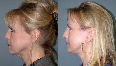 45-54 year old woman treated with Facelift - This 50 year old woman presented requesting facial rejuvenation. She had a brow lift, upper eyelid lift, and lower face and neck lift. She is 5'5 tall and weighs 125 lbs. her results are shown a 6 months after the procedure.