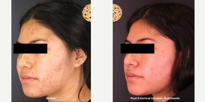 18-24 year old woman treated with Dermalinfusion - Dermal Infusion - Before & After