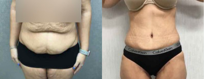 Patient treated with Tummy Tuck - Patient treated with Tummy Tuck