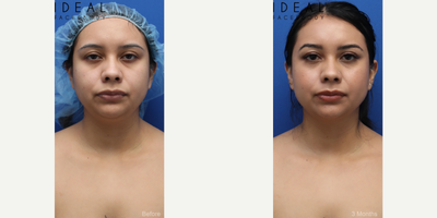 25-34 year old woman treated with awake liposculpting of the chin, neck, and jawline using Precision Sculpt - This procedure is performed in the office with oral sedation and complete local anesthesia. Three tiny hidden skin openings are made. A laser is passed through the excess fat to help loosen it and prepare it for smooth removal. A specialized powered handpiece with micro lipo cannulas is meticulously guided throughout the excess fat to fully sculpt the entire anterior neck from the lower jowls, jaw / mandible, chin, and neck.